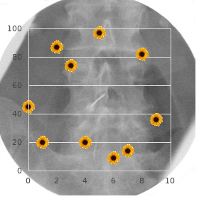 Cranioectodermal dysplasia