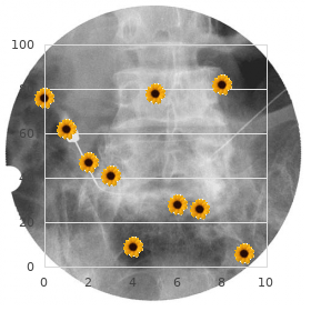 Arthrogryposis multiplex congenita CNS calcification