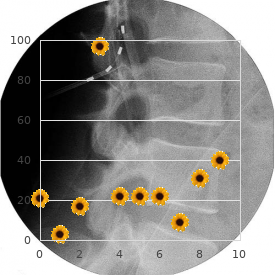 Central type neurofibromatosis