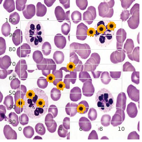 Acute monoblastic leukemia