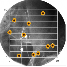 Partial lissencephaly