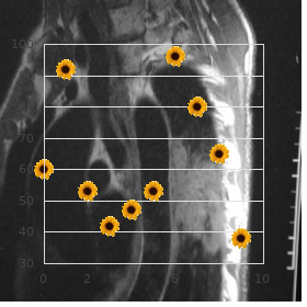 OSLAM syndrome