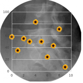 Scapuloperoneal myopathy