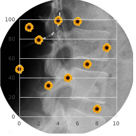 Peritonitis