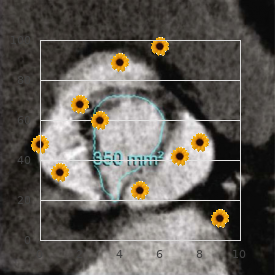 Fronto-facio-nasal dysplasia