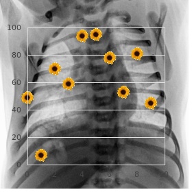 Hereditary spherocytosis