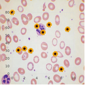 Acute myeloblastic leukemia type 7