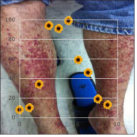 Osgood Schlatter disease