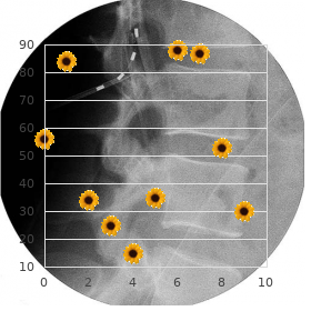 Cervicooculoacoustic syndrome