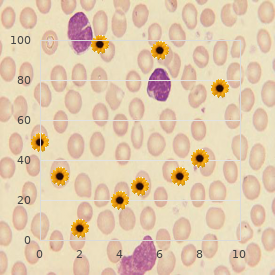 Chromosome 17, trisomy 17q22