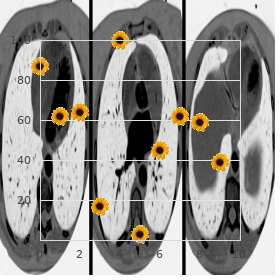 Thalamic syndrome