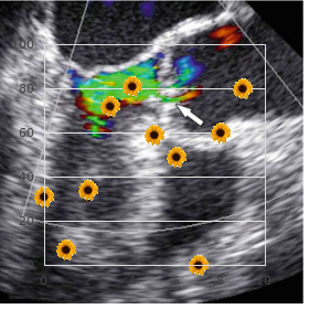 Biliary atresia, intrahepatic, non syndromic form