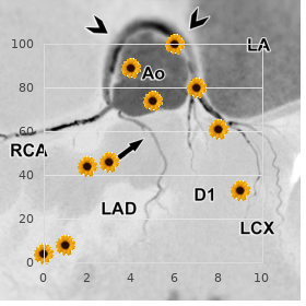 Chromosome 21 ring