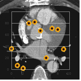 Peters anomaly with cataract