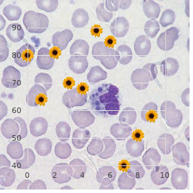 Myasthenia gravis congenital