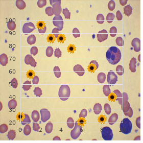 Pyrimidinemia familial