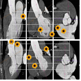 Contractural arachnodactyly