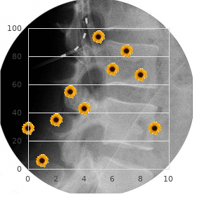 Multiple joint dislocations metaphyseal dysplasia