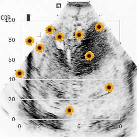 Renal dysplasia mesomelia radiohumeral fusion