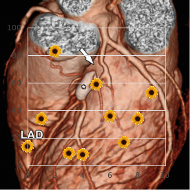 Revesz syndrome