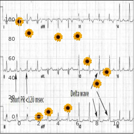 Posterior urethral valves