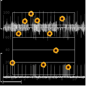 Hyperimmunoglobulinemia D with periodic fever