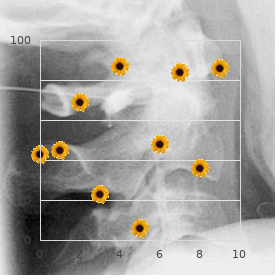 Amaurosis hypertrichosis