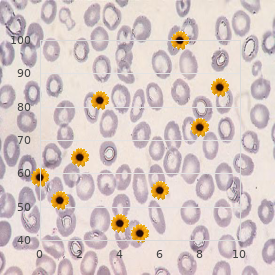 Axial mesodermal dysplasia