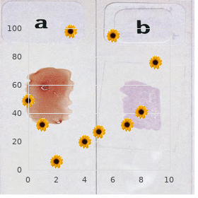 Factor V Leiden mutation