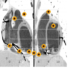 Arrythmogenic right ventricular dysplasia, familial