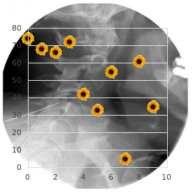 Acute idiopathic polyneuritis