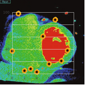 Von Willebrand disease