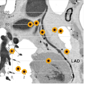 Kallmann syndrome with Spastic paraplegia