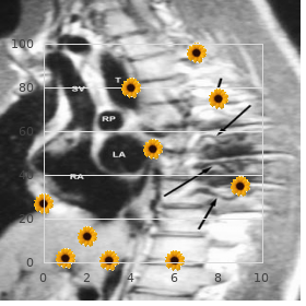 Neuroepithelioma