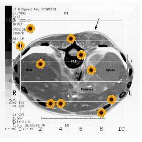 Wildervanck syndrome