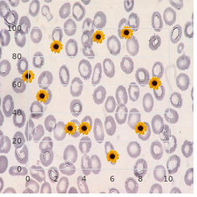 Chromosome 16, trisomy 16q