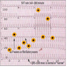 Wallis Zieff Goldblatt syndrome