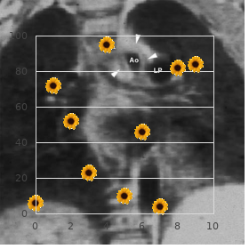 Corticobasal degeneration