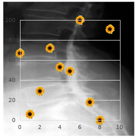 Pseudoachondroplastic dysplasia