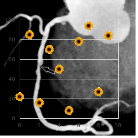 Endometrial stromal sarcoma