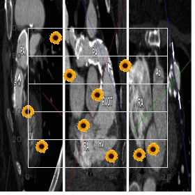 Congenital heart disease radio ulnar synostosis mental retardation