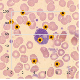 Arteriovenous malformation