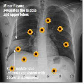 Osteoporosis macrocephaly mental retardation blindness