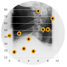 Diffuse leiomyomatosis with Alport syndrome