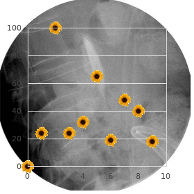 Radial hypoplasia, triphalangeal thumbs and hypospadias