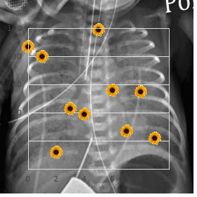 Ectodermal dysplasia mental retardation syndactyly