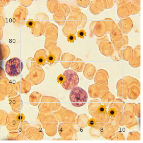 Waardenburg syndrome type 2B