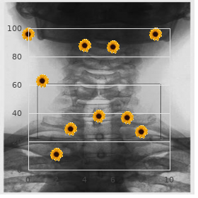 Rhabdomyosarcoma 2