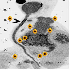 Ectodermal dysplasia