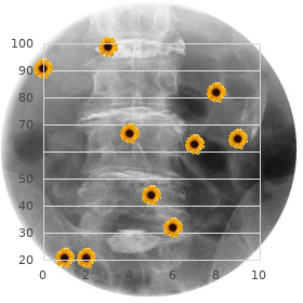 Osteopetrosis, mild autosomal recessive form